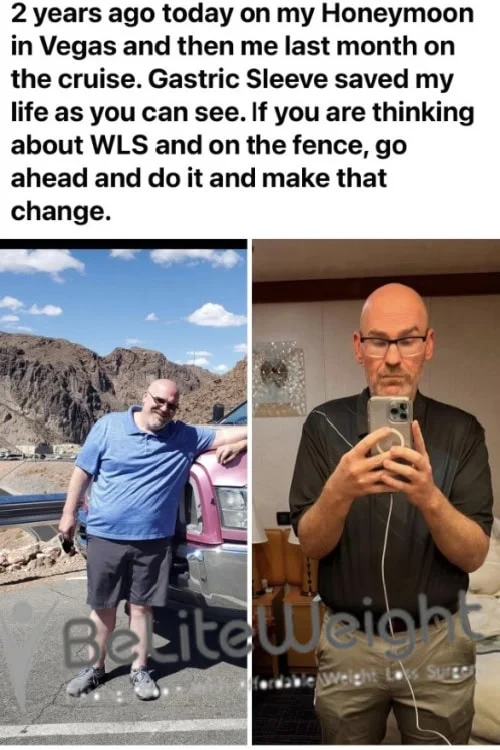 Weight Loss Surgery Gastric Sleeve before and after David W - 5 Month Update*